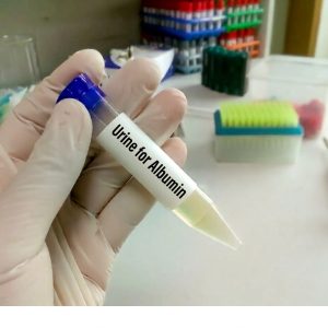 Urine for Albumin